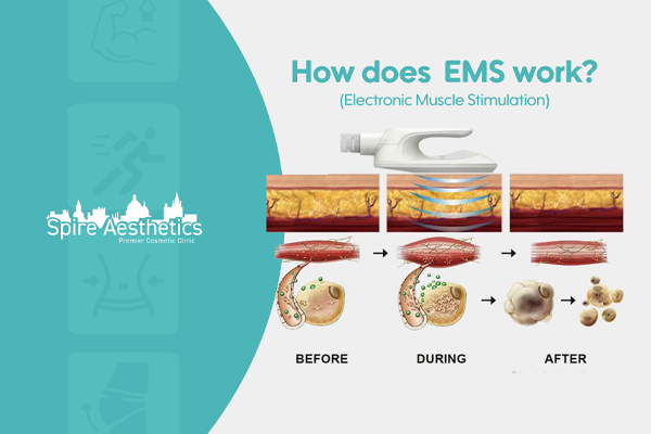 EMS treatment for post pregnancy weight loss treatment Chester