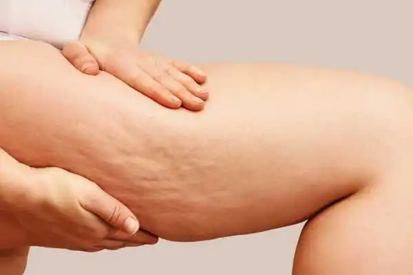 Image of woman showing leg with cellulite Chester