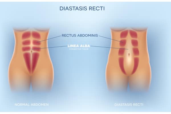 What Non-Surgical Options Are Available for Diastasis Recti Chester?