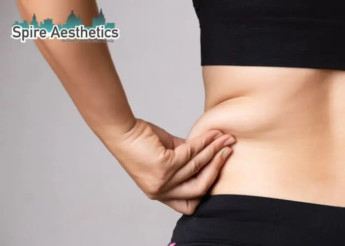 Image of woman pinching fat on their hips Chester. Fat Freezing treatment