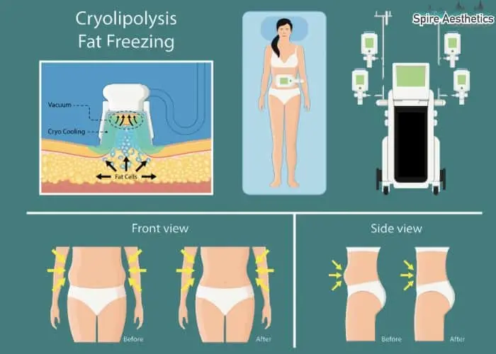 Fat freezing treatment Chester benefits for competitions to remove stubborn fat deposits.