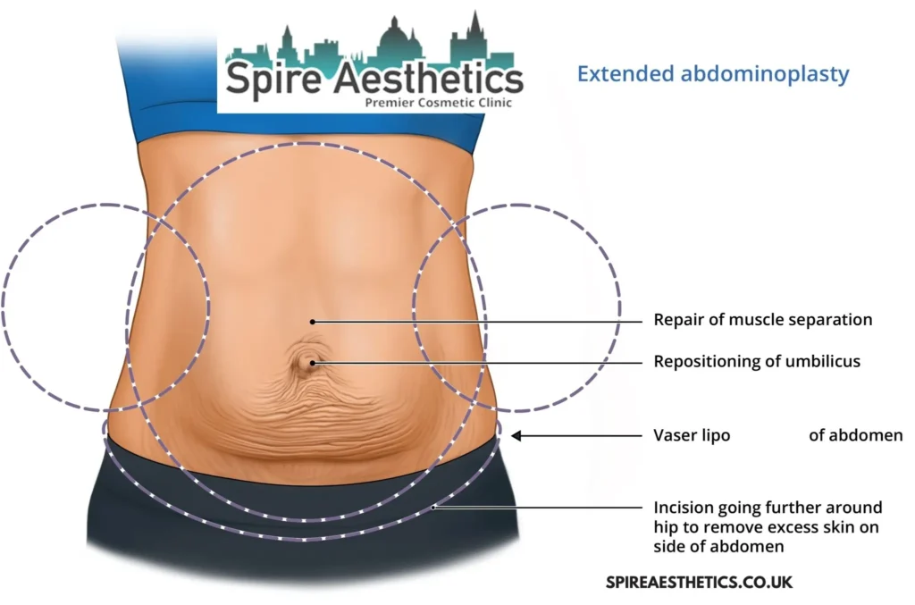 Understanding Loose Skin After Gastric Band Chester Surgery and HIFU Treatment