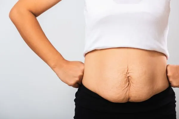 Image of a woman's stomach after weight loss with sagging skin following a gastric band Chester
