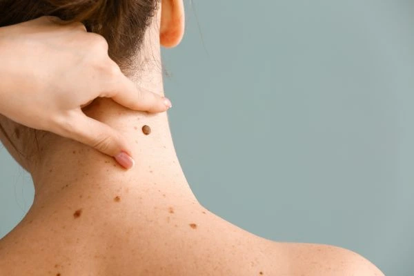 skin blemish removal Chester treatment