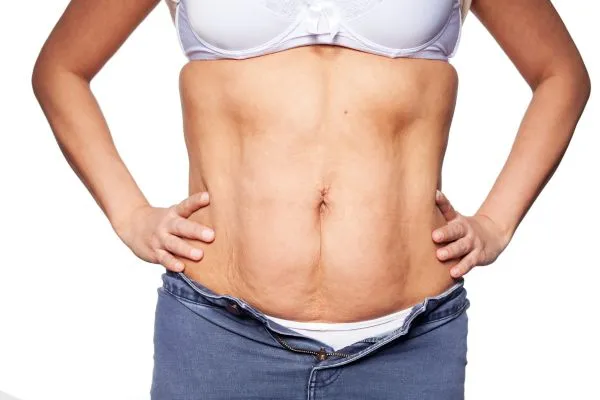 sagging skin on woman's stomach after weight loss injections Chester