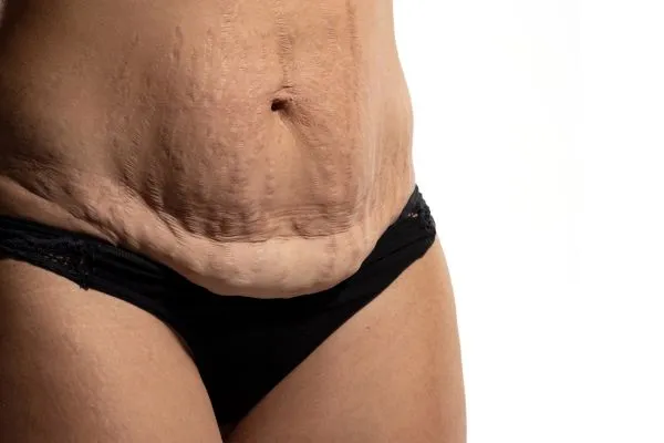 Image of womans stomach after weight loss injections Chester showing saggy skin