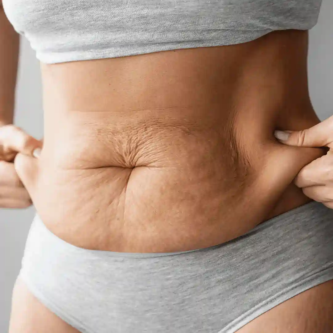 Is It Normal to Have Loose Skin After Pregnancy Chester?