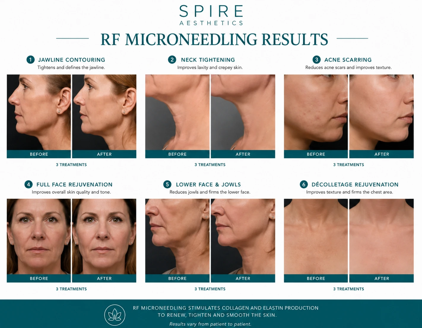 RF Microneedling Skin tightening Chester results