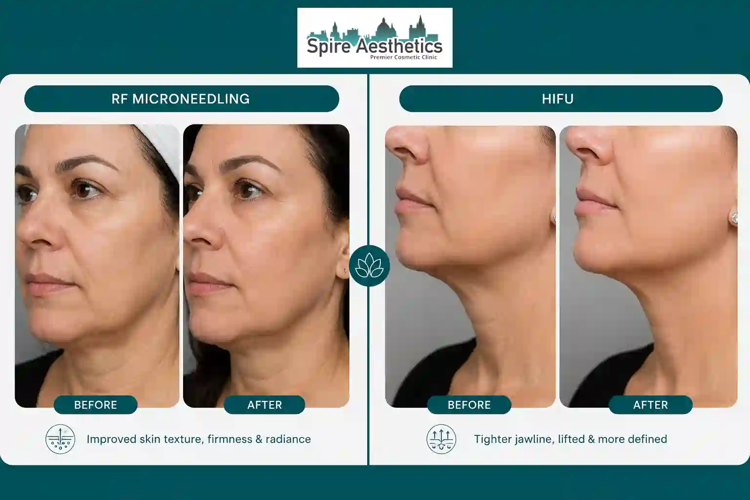 Can RF Microneedling and HIFU Be Combined Chester?