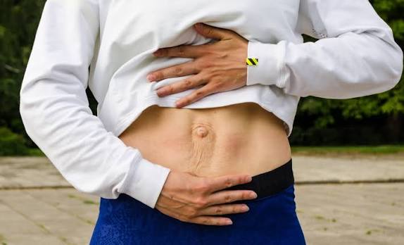 When Could Diastasis Recti Be the Missing Piece of the Puzzle Chester?