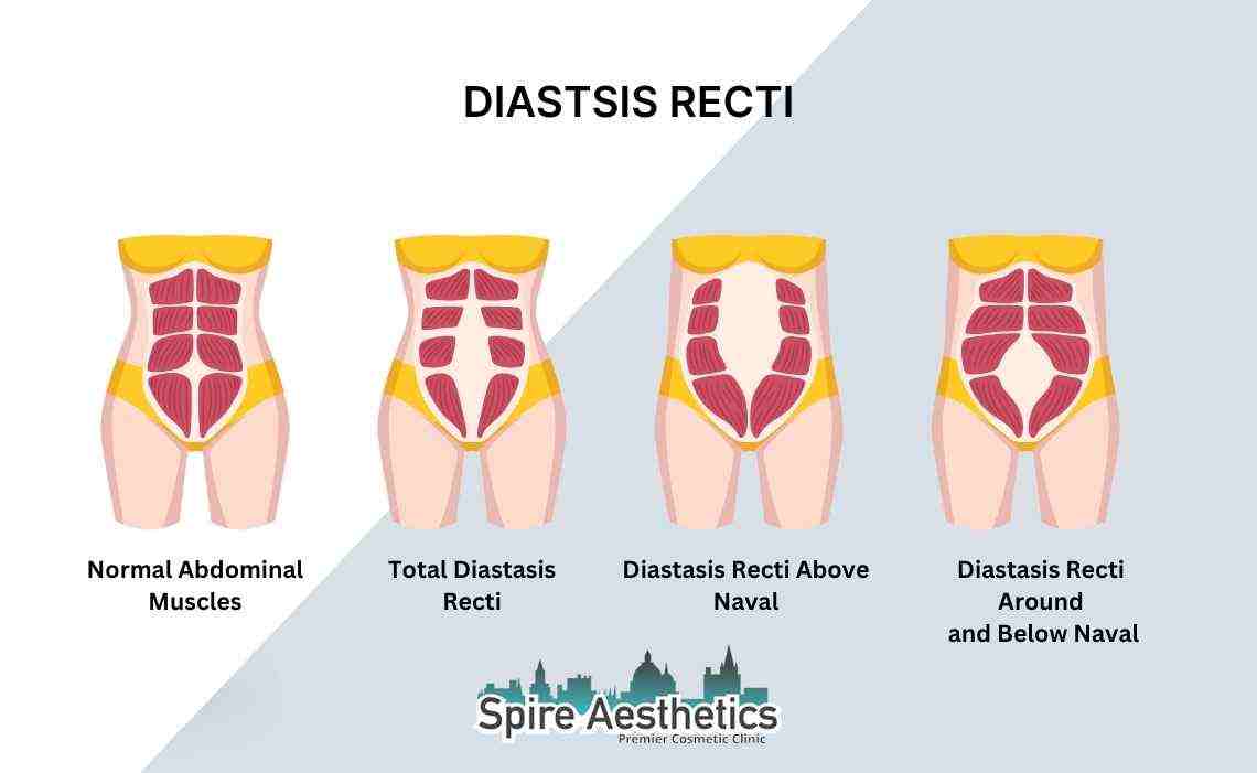 Is Non-Surgical Diastasis Recti Treatment Right for You? Common Concerns Answered Chester